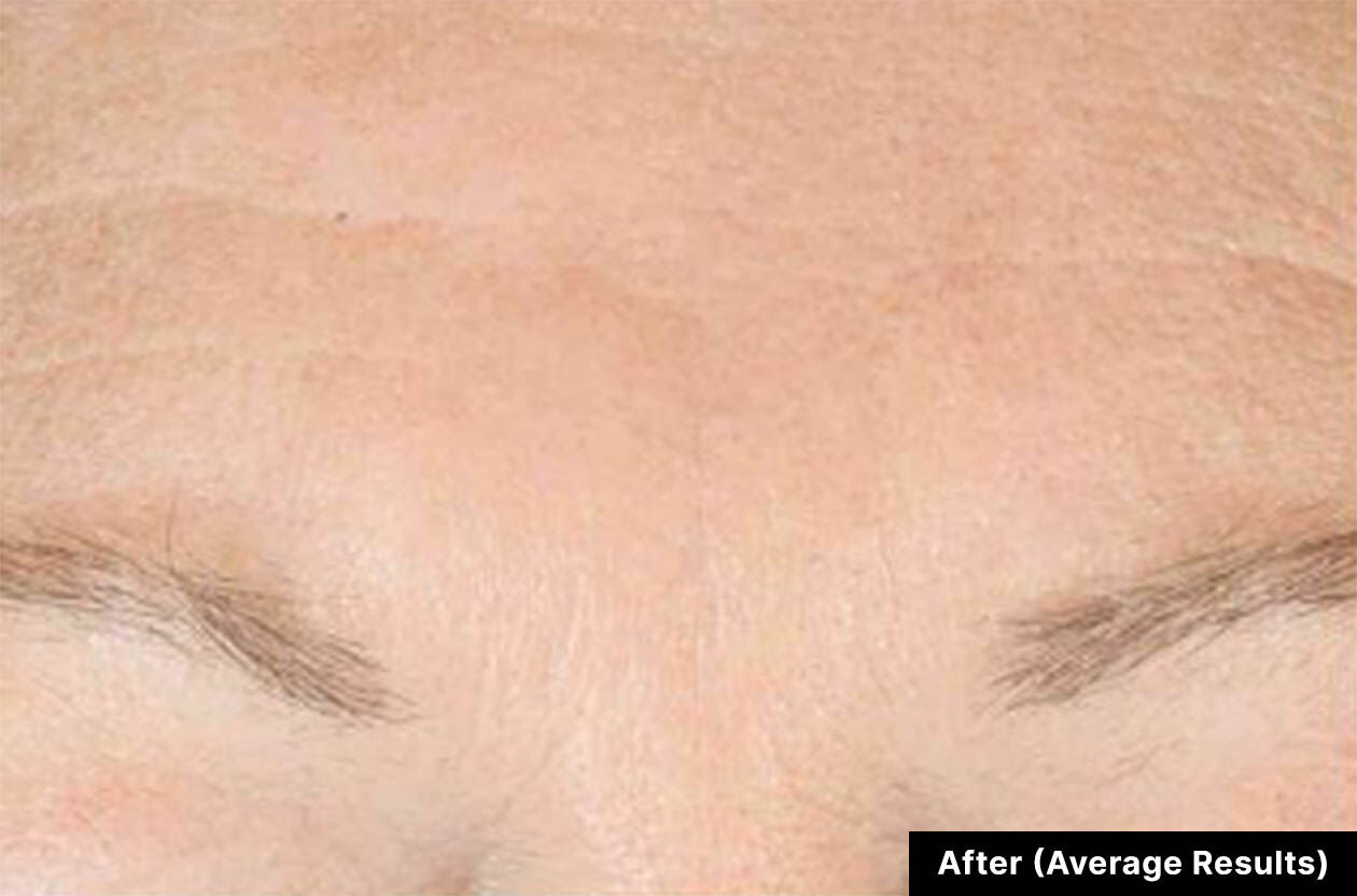 Close-up of a smooth forehead with subtle wrinkles, labeled 'After (Average Results)' indicating improvement.