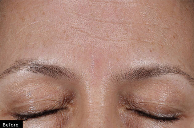 Avant un traitement esthetique, gros plan sur le front d'une personne aux yeux fermes, montrant des ridules et une peau lisse.