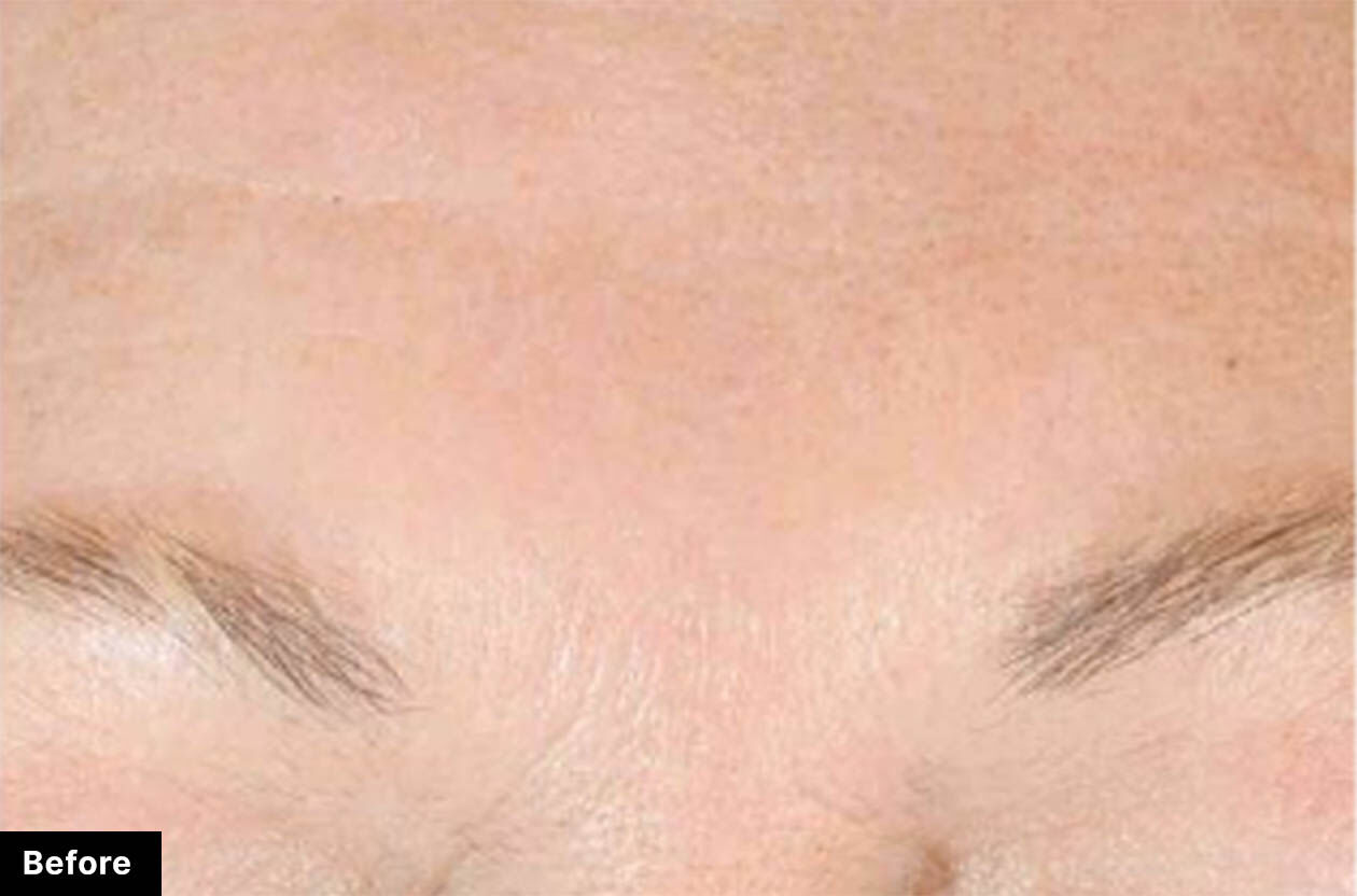 Close-up of a forehead with minimal wrinkles and natural skin tone, labeled as 'Before.'