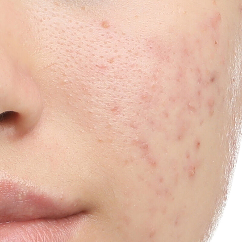 Close-up of a person's face showing skin with visible acne and texture variances.