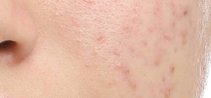 Close-up of a person's face showing skin with visible acne and texture variances.