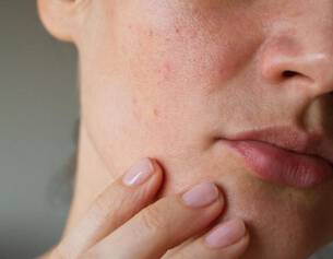 que faire contre les taches pigmentaires