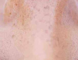 tout-savoir-sur-acide-glycolique