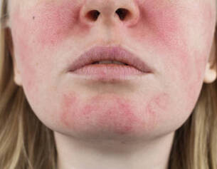 causes et solutions rougeurs visage