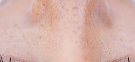 Close-up of a person's forehead and eyes, showcasing natural skin with freckles and long eyelashes.