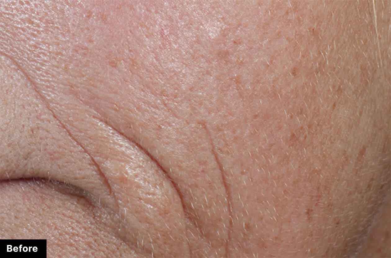 Close-up of skin showing fine lines and wrinkles, representing the 'before' state in a skincare treatment evaluation.