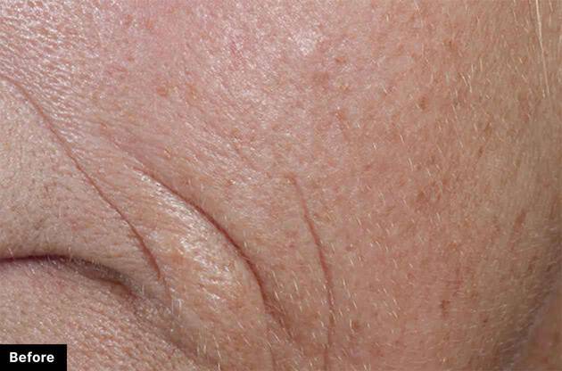 Close-up of skin showing fine lines and wrinkles, representing the 'before' state in a skincare treatment evaluation.