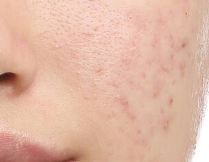 een-reactieve-of-overgevoelige-huid-tijdelijk