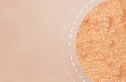 Close-up of textured skin, showing pores and small imperfections, against a soft blurred background.