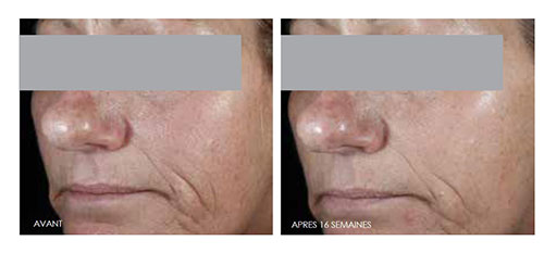 CEFerulic-Avant-Apres